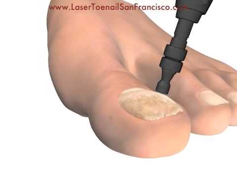 Toenail Fungus – cryotherapy, treat heel pain, plantar fasciitis, neuromas Pittsburgh PA Toenail Fungus – cryotherapy, treat heel pain, plantar fasciitis, neuromas Pittsburgh PA