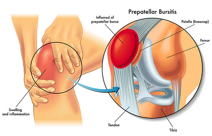 Patellar Tendon Irritation - Treatment & Prevention– Bauerfeind