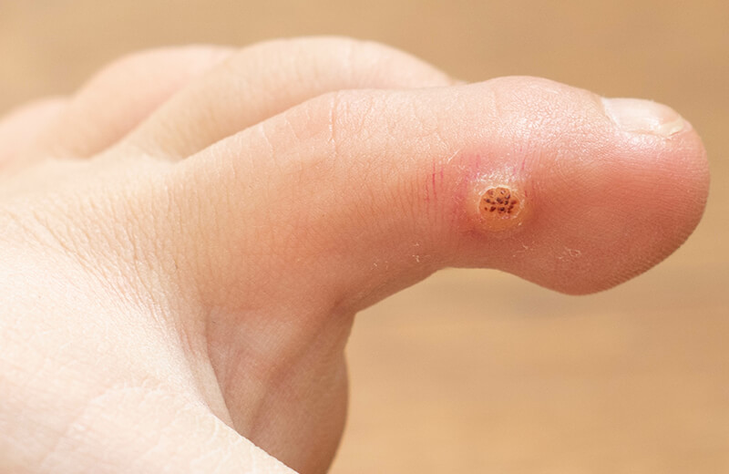 What Causes Plantar Warts On Fingers - Infoupdate.org