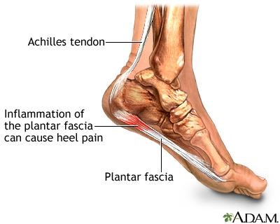 The Consequences of Leaving Plantar Fasciitis Untreated - Plantar