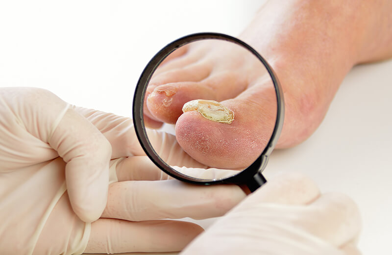 Toenail Fungus – cryotherapy, treat heel pain, plantar fasciitis, neuromas  Pittsburgh PA