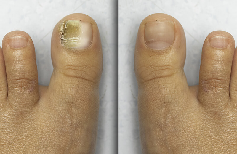 Might the marked area be an early stage of nail fungus? (description in  comments) : r/NailFungus